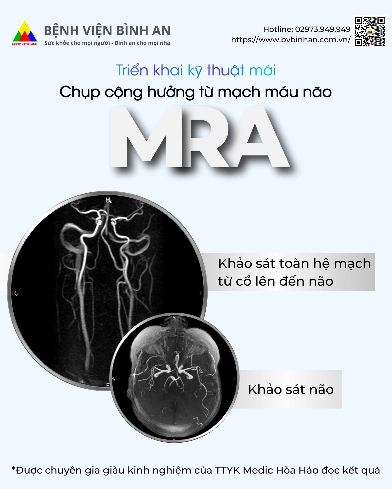 Triển khai kỹ thuật mới: chụp cộng hưởng từ mạch máu não (MRA) tại Bệnh viện Bình An